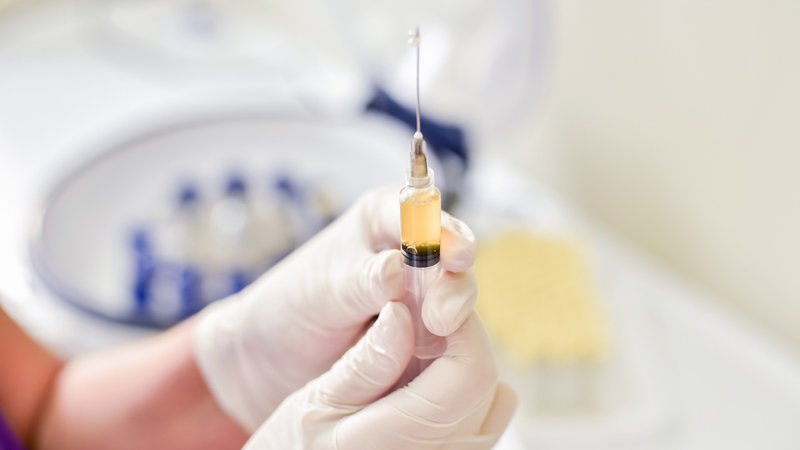 platelet-rich plasma injection for peyronie's disease