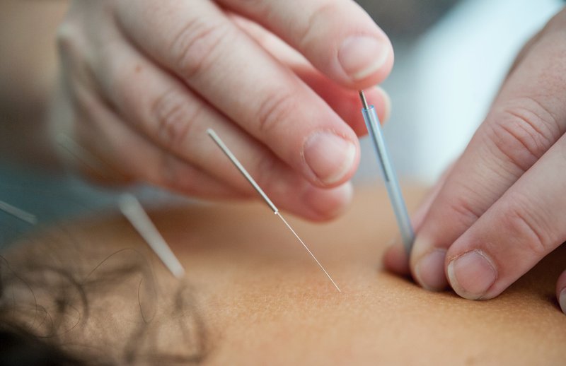 acupuncture therapy to improve performance and overall well-being